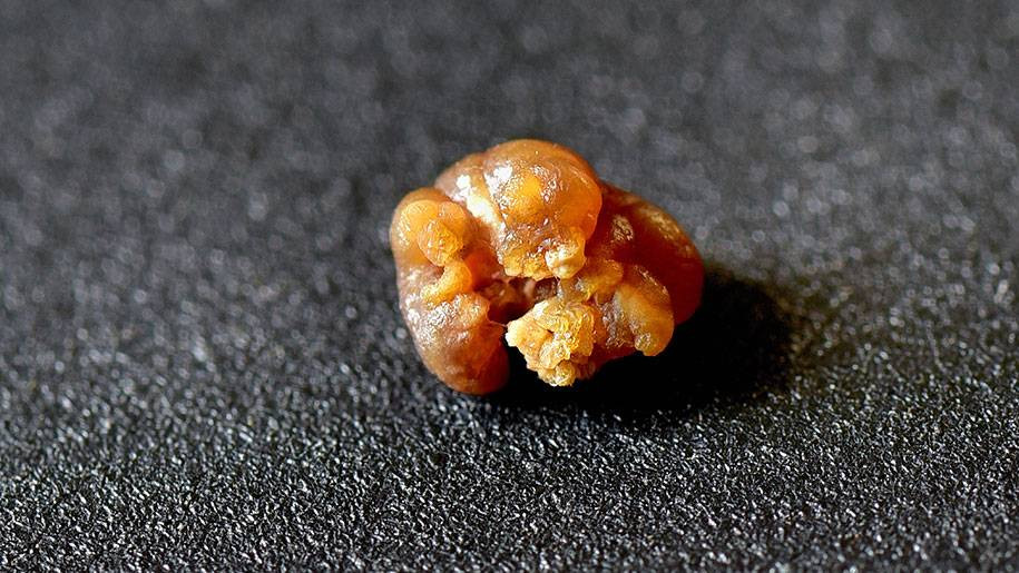 Havalar ısındı böbrek taşına dikkat! Uzman isim uyardı - Resim: 22